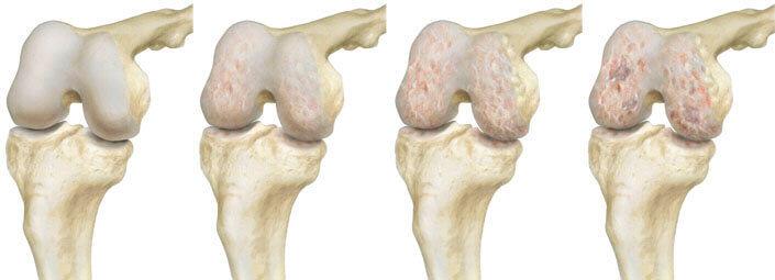 Боль в колене (болит коленный сустав)
